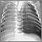 Pneumothorax - chest X-ray