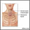 Retrosternal thyroid