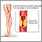 Arteriosclerosis of the extremities