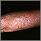 Actinic keratosis on the arm