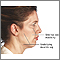 Facelift - series - Indications