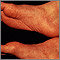 Reactive arthritis - view of the feet