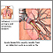 Causes of acute bronchitis