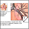 Causes of chronic bronchitis