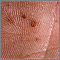 Basal cell nevus syndrome - close-up of palm