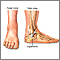 Ankle sprain - Series