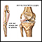 Knee misaligned due to arthritis