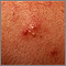 Acne - close-up of pustular lesions