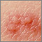Herpes zoster (shingles) - close-up of lesion