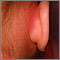 Mastoiditis - redness and swelling behind ear