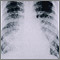 Chickenpox, acute pneumonia - chest X-ray