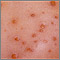 Chickenpox - close-up