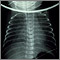 Totally anomalous pulmonary venous return - X-ray
