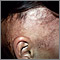 Alopecia, under treatment