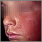 Dermatitis - contact on the cheek