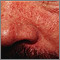 Dermatitis seborrheic - close-up