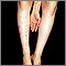 Dermatitis - herpetiformis on the arm and legs