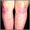 Dermatomyositis on the legs