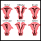 Congenital uterine anomalies
