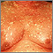 Pityriasis rubra pilaris on the chest