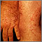 Ringworm - tinea on the hand and leg
