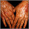 Skin cancer - squamous cell on the hands