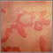 Hives (urticaria) - close-up