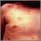 Urticaria pigmentosa on the chest