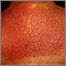 Lichen simplex chronicus on the back