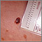 Skin cancer - close-up of level III melanoma