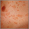 Pityriasis rosea on the chest