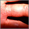 Herpes zoster (shingles) on the hand and fingers