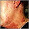 Herpes zoster (shingles) on the neck and cheek