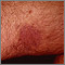 Kaposi sarcoma on the thigh