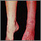 Sturge-Weber syndrome - legs