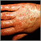 Vasculitis - urticarial on the hand