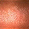 Lichen striatus - close-up