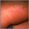 Lichen striatus on the leg