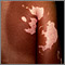 Vitiligo on the back and arm