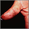 Dermatitis herpetiformis on the thumb
