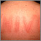 Dermatographism on the back