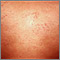 Hives (urticaria) on the chest