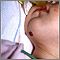 Hemangioma on the chin