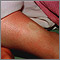Pitting edema on the leg