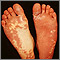Sturge-Weber syndrome - soles of feet