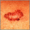 Basal cell carcinoma - close-up