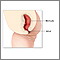 Imperforate anus repair - series