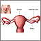 Tubal ligation - uterine anatomy