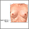 Supernumerary nipples