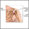 Shoulder joint inflammation